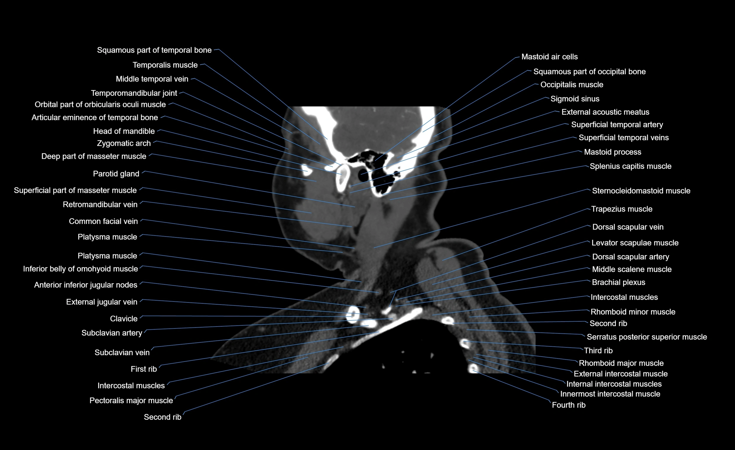 Neck CT sagittal cross sectional anatomy 3D  radiology  image-img-00001-00020.webp